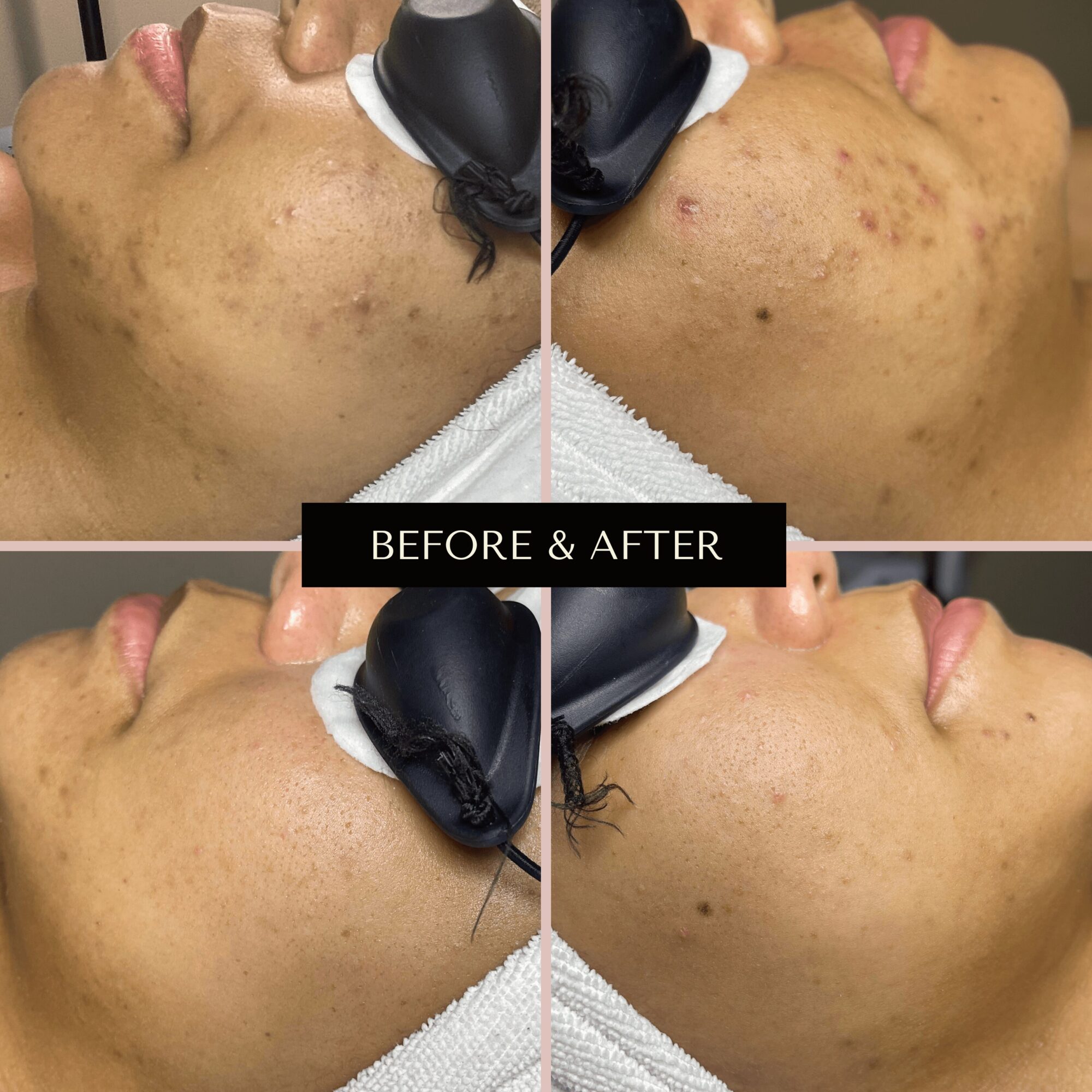 Side-by-side comparison of skin before and after treatment showing reduced acne and scars.